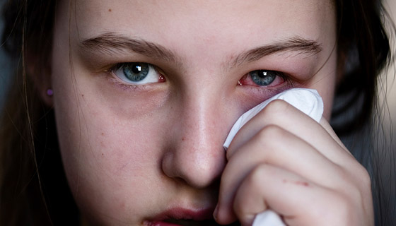إنفلونزا العيون.. طرق الوقاية والتغلب على الأعراض المزعجة صورة رقم 2