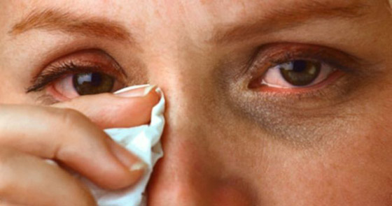 إنفلونزا العيون.. طرق الوقاية والتغلب على الأعراض المزعجة صورة رقم 4