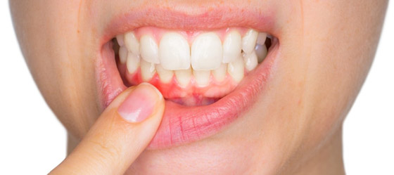 احذروا.. ربما تفقدون أسنانكم بسبب التهاب اللثة!! صورة رقم 1