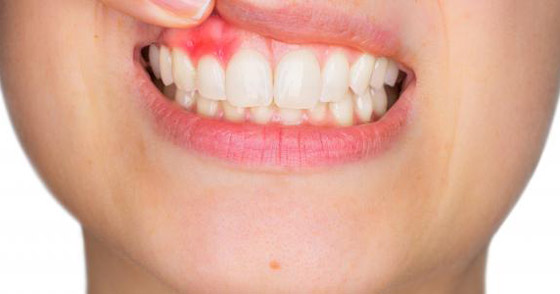 احذروا.. ربما تفقدون أسنانكم بسبب التهاب اللثة!! صورة رقم 3