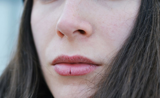 لهذا السبب.. لا تلعق شفاهك في فصل الشتاء البارد! صورة رقم 2