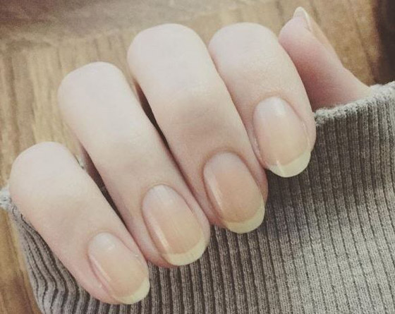 الأظافر الصفراء.. الأسباب والعلامات وطرق العلاج صورة رقم 3