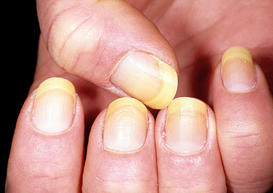 الأظافر الصفراء.. الأسباب والعلامات وطرق العلاج صورة رقم 2