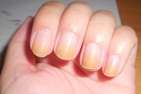 الأظافر الصفراء.. الأسباب والعلامات وطرق العلاج صورة رقم 4