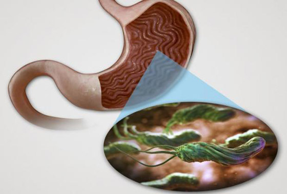 هل جرثومة المعدة قاتلة؟ تعرف على عوارضها وكيفية التخلص منها نهائيا صورة رقم 2 هل جرثومة المعدة قاتلة؟ تعرف على عوارضها وكيفية التخلص منها نهائيا صورة رقم 2