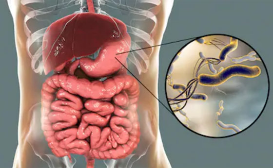 هل جرثومة المعدة قاتلة؟ تعرف على عوارضها وكيفية التخلص منها نهائيا صورة رقم 9 هل جرثومة المعدة قاتلة؟ تعرف على عوارضها وكيفية التخلص منها نهائيا صورة رقم 9