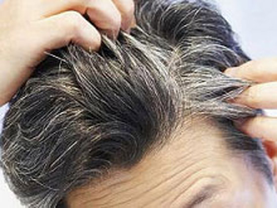 لماذا يشيب الشعر ويتحول لونه للرمادي أو الأبيض في سن مبكرة؟ صورة رقم 8 لماذا يشيب الشعر ويتحول لونه للرمادي أو الأبيض في سن مبكرة؟ صورة رقم 8