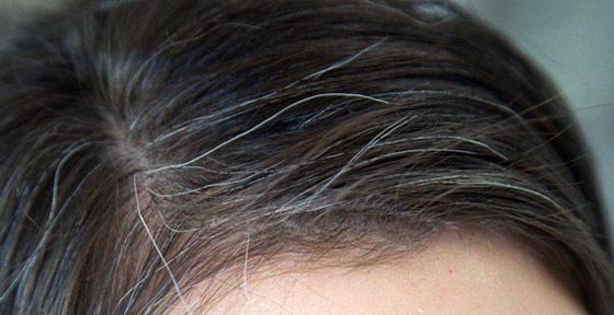 لماذا يشيب الشعر ويتحول لونه للرمادي أو الأبيض في سن مبكرة؟ صورة رقم 7 لماذا يشيب الشعر ويتحول لونه للرمادي أو الأبيض في سن مبكرة؟ صورة رقم 7