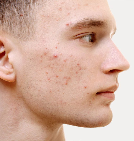 نصائح غذائية للقضاء على حب الشباب.. تعرف عليها! صورة رقم 5 نصائح غذائية للقضاء على حب الشباب.. تعرف عليها! صورة رقم 5