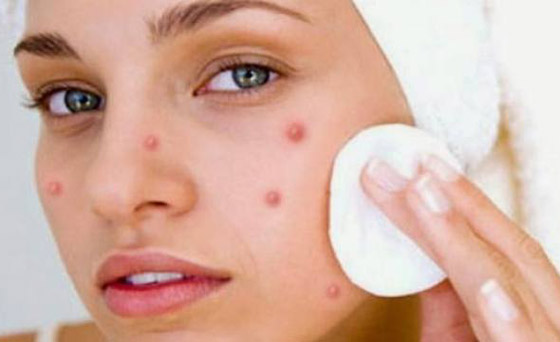 نصائح غذائية للقضاء على حب الشباب.. تعرف عليها! صورة رقم 9 نصائح غذائية للقضاء على حب الشباب.. تعرف عليها! صورة رقم 9