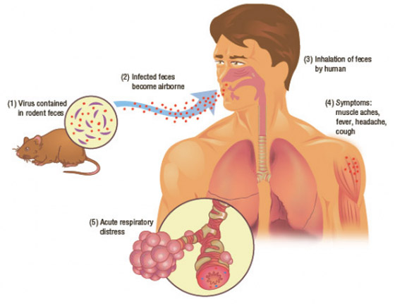 بعد إعلان الصين عن حالة وفاة.. كل ما تريد معرفته عن فيروس هانتا! صورة رقم 5