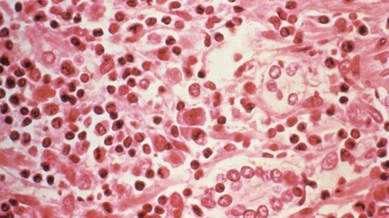 بعد إعلان الصين عن حالة وفاة.. كل ما تريد معرفته عن فيروس هانتا! صورة رقم 16