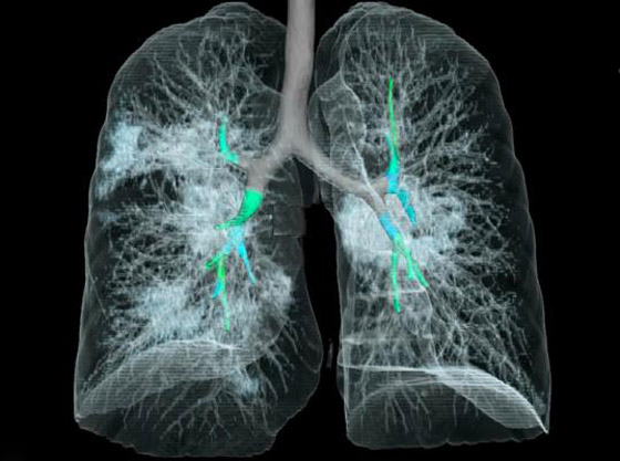 بالفيديو.. كيف تبدو رئة مصاب بفيروس كورونا وما يحصل داخلها؟ صورة رقم 1