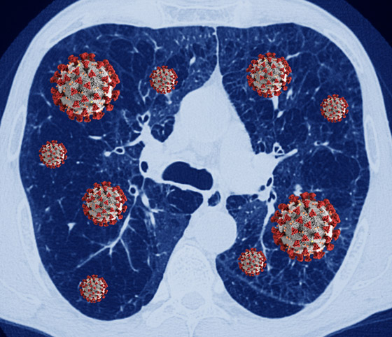 بالفيديو.. كيف تبدو رئة مصاب بفيروس كورونا وما يحصل داخلها؟ صورة رقم 10