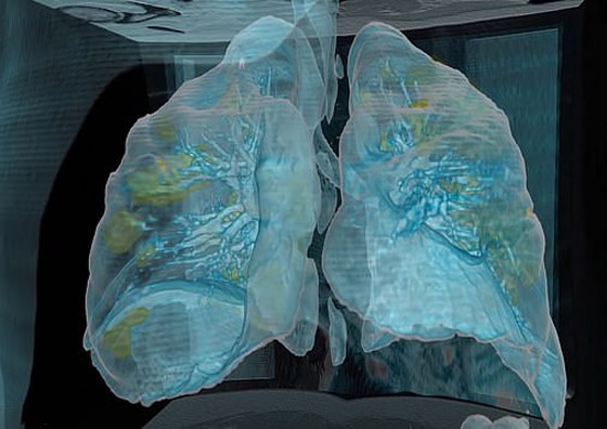 بالفيديو.. كيف تبدو رئة مصاب بفيروس كورونا وما يحصل داخلها؟ صورة رقم 2
