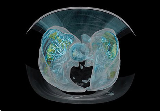 بالفيديو.. كيف تبدو رئة مصاب بفيروس كورونا وما يحصل داخلها؟ صورة رقم 3