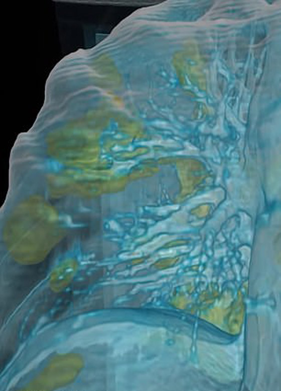 بالفيديو.. كيف تبدو رئة مصاب بفيروس كورونا وما يحصل داخلها؟ صورة رقم 7
