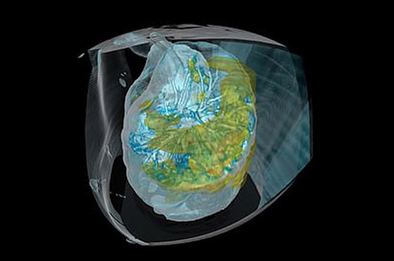 بالفيديو.. كيف تبدو رئة مصاب بفيروس كورونا وما يحصل داخلها؟ صورة رقم 5