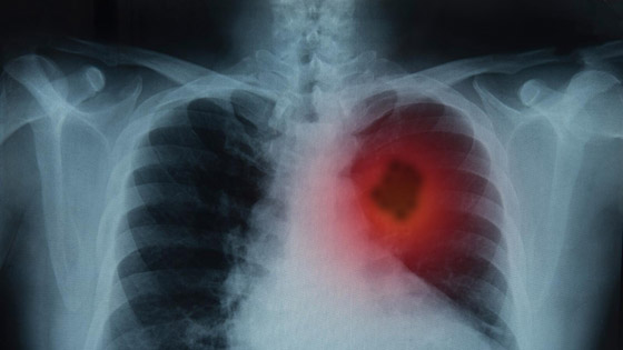 5 أطعمة لتعزيز صحة الجهاز التنفسي والرئتين صورة رقم 6