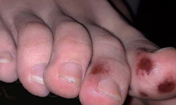 أعراض جديدة وغامضة لمصابي كورونا من الأطفال والمراهقين! صورة رقم 2