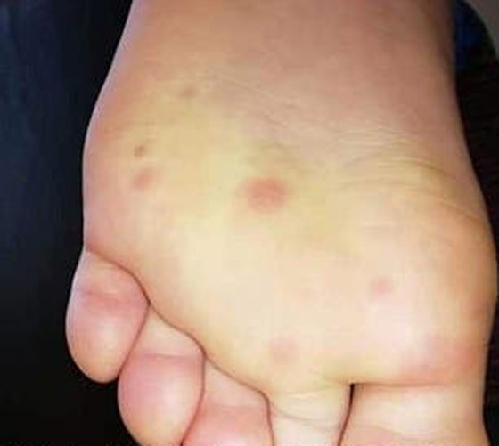 أعراض جديدة وغامضة لمصابي كورونا من الأطفال والمراهقين! صورة رقم 5