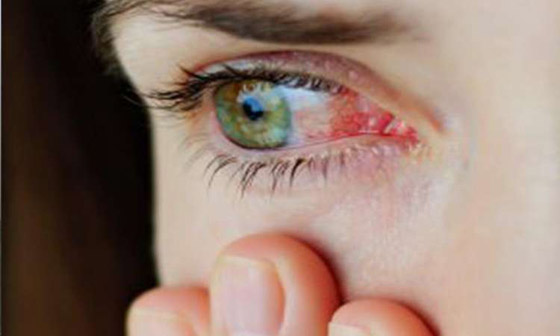 ما هي متلازمة عين المكتب؟ ان كنت تستعمل الكمبيوتر كثيرا قد تصيبك! صورة رقم 7