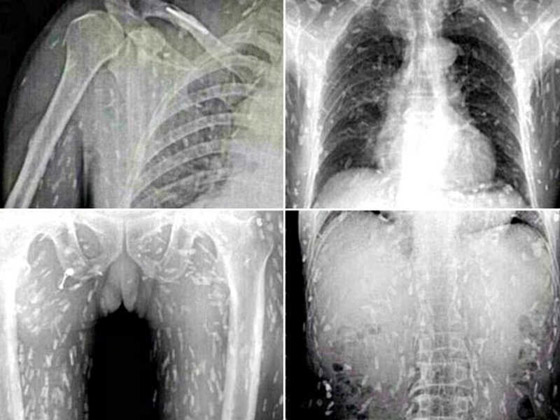 بالصور: تعرفوا على الكائنات الحية التي تعيش بداخل جسم الإنسان! صورة رقم 4
