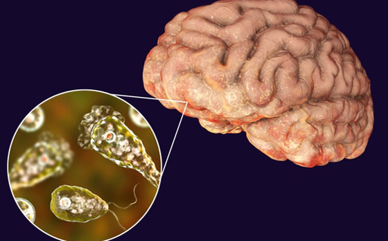 يصيب الدماغ ويدمره.. رصد أولى حالات لمرض خطير والأطباء بحالة رعب صورة رقم 2 يصيب الدماغ ويدمره.. رصد أولى حالات لمرض خطير والأطباء بحالة رعب صورة رقم 2