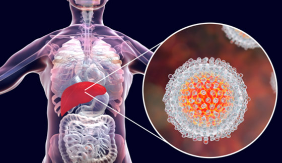 إليك كل ما تريد معرفته عن التهاب الكبد وأنواعه وأسبابه وأعراضه! صورة رقم 1
