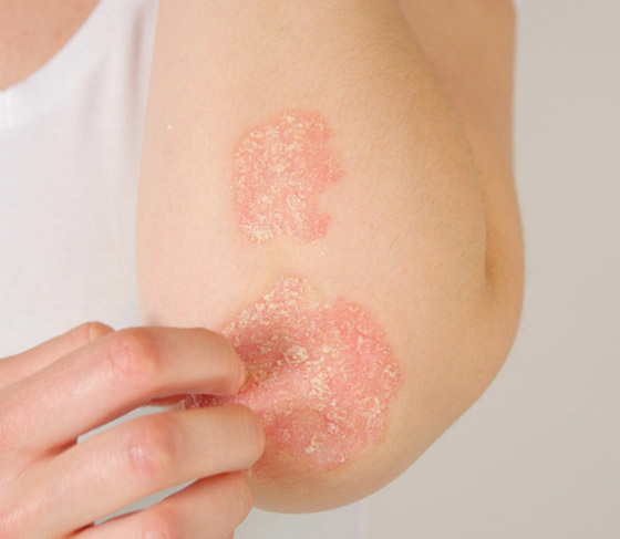 تعرفوا على أسباب الصدفية، أنواعها وأعراضها، طرق علاجها ومضاعفاتها صورة رقم 4