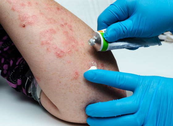 تعرفوا على أسباب الصدفية، أنواعها وأعراضها، طرق علاجها ومضاعفاتها صورة رقم 8