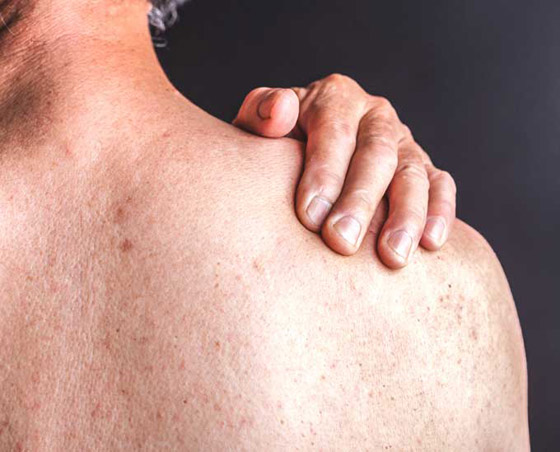 تعرفوا على أسباب الصدفية، أنواعها وأعراضها، طرق علاجها ومضاعفاتها صورة رقم 12