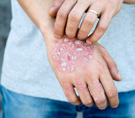 تعرفوا على أسباب الصدفية، أنواعها وأعراضها، طرق علاجها ومضاعفاتها صورة رقم 14