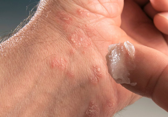 تعرفوا على أسباب الصدفية، أنواعها وأعراضها، طرق علاجها ومضاعفاتها صورة رقم 11