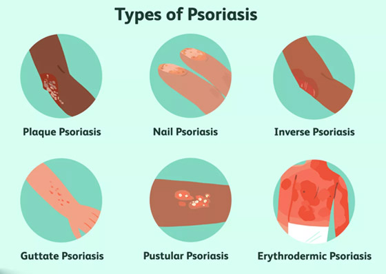 تعرفوا على أسباب الصدفية، أنواعها وأعراضها، طرق علاجها ومضاعفاتها صورة رقم 5