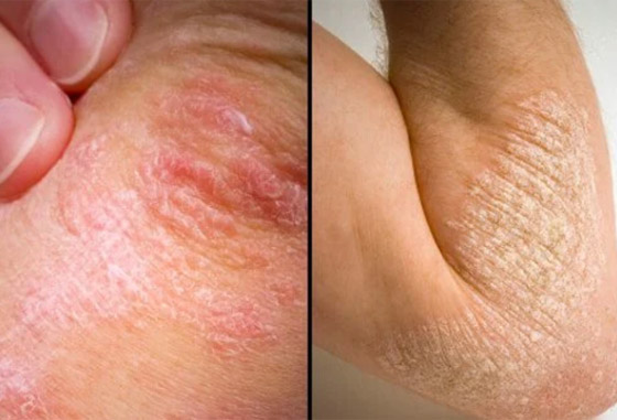 تعرفوا على أسباب الصدفية، أنواعها وأعراضها، طرق علاجها ومضاعفاتها صورة رقم 15