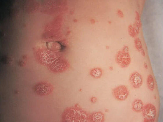 تعرفوا على أسباب الصدفية، أنواعها وأعراضها، طرق علاجها ومضاعفاتها صورة رقم 16