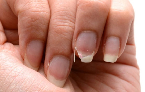 كيف تصلحين الظفر المكسور؟ الخبراء يقدمون لكِ 3 حلول..! صورة رقم 2