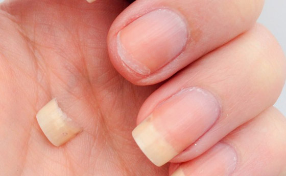 كيف تصلحين الظفر المكسور؟ الخبراء يقدمون لكِ 3 حلول..! صورة رقم 5