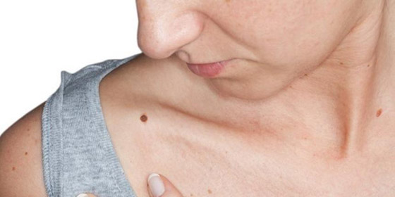 تعرفي على شخصيتك حسب موقع شامتك صورة رقم 3