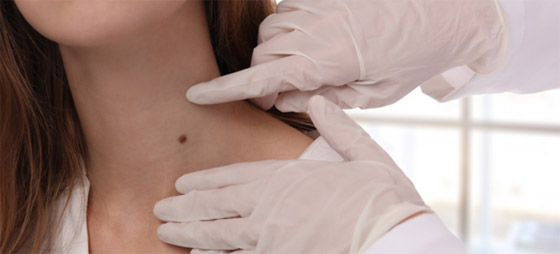 تعرفي على شخصيتك حسب موقع شامتك صورة رقم 2