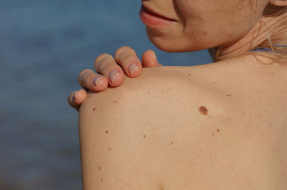 تعرفي على شخصيتك حسب موقع شامتك صورة رقم 4