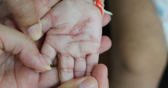 حقائق هامة عن بكتيريا الدم والأشخاص الأكثر عرضه بالإصابه به صورة رقم 2