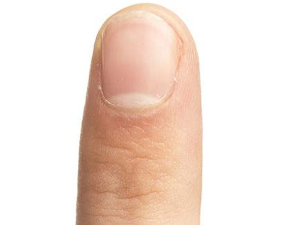 أظافرك مرآة لصحتك.. لون وشكل وملمس الأظافر يكشفون الأمراض! صورة رقم 1 أظافرك مرآة لصحتك.. لون وشكل وملمس الأظافر يكشفون الأمراض! صورة رقم 1