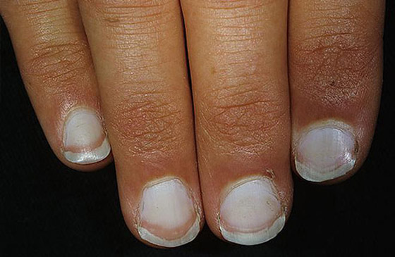 أظافرك مرآة لصحتك.. لون وشكل وملمس الأظافر يكشفون الأمراض! صورة رقم 2 أظافرك مرآة لصحتك.. لون وشكل وملمس الأظافر يكشفون الأمراض! صورة رقم 2