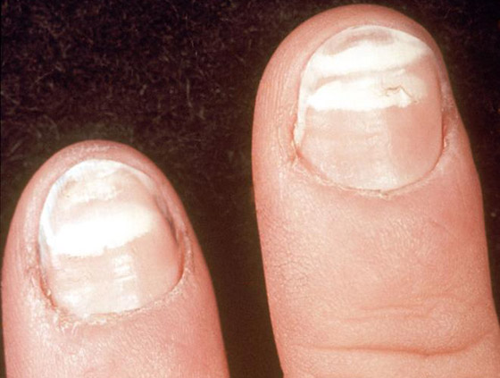 أظافرك مرآة لصحتك.. لون وشكل وملمس الأظافر يكشفون الأمراض! صورة رقم 3 أظافرك مرآة لصحتك.. لون وشكل وملمس الأظافر يكشفون الأمراض! صورة رقم 3