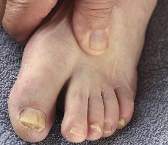 أظافرك مرآة لصحتك.. لون وشكل وملمس الأظافر يكشفون الأمراض! صورة رقم 4 أظافرك مرآة لصحتك.. لون وشكل وملمس الأظافر يكشفون الأمراض! صورة رقم 4