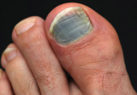 أظافرك مرآة لصحتك.. لون وشكل وملمس الأظافر يكشفون الأمراض! صورة رقم 5 أظافرك مرآة لصحتك.. لون وشكل وملمس الأظافر يكشفون الأمراض! صورة رقم 5