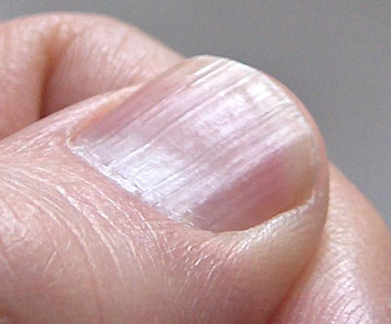 أظافرك مرآة لصحتك.. لون وشكل وملمس الأظافر يكشفون الأمراض! صورة رقم 8 أظافرك مرآة لصحتك.. لون وشكل وملمس الأظافر يكشفون الأمراض! صورة رقم 8