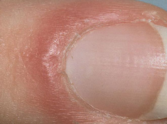 أظافرك مرآة لصحتك.. لون وشكل وملمس الأظافر يكشفون الأمراض! صورة رقم 9 أظافرك مرآة لصحتك.. لون وشكل وملمس الأظافر يكشفون الأمراض! صورة رقم 9